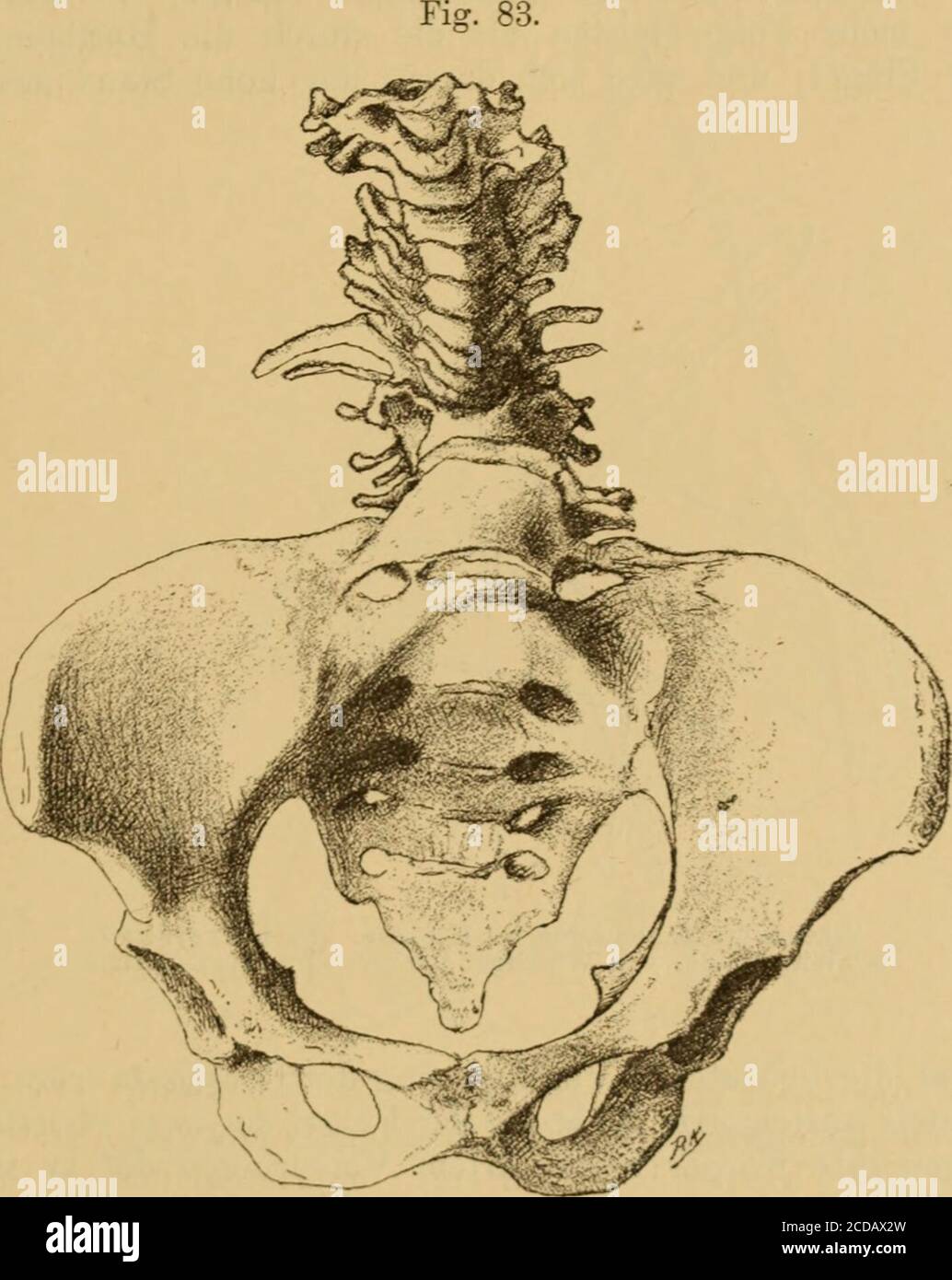 . Handbuch der Geburtshülfe . Kyphosis dorsoliunbalis (Prager path.-auat. Museum Nr. 310). die Drehungsachse des Beckens fällt, und nun die Wirkung einer beidieser aufrechten Haltung zu Stande kommenden Einknickung der Wirbel-säule nach hinten vorstellen. In Folge dieser Einknickung muss der Die Beckenformen bei Kyphose. 427 oberhalb des Gibbus liegende Theil des Rumpfes nach vorne fallen unddemgemäss wegen mangelnder Unterstützung des Schwerpunktes, auchder ganze Körper nach vorne umfallen. Soll nun trotzdem der Kör-per in aufrechter Stellung balancirt werden, so muss, damit derSchwerpunkt ne Stock Photo