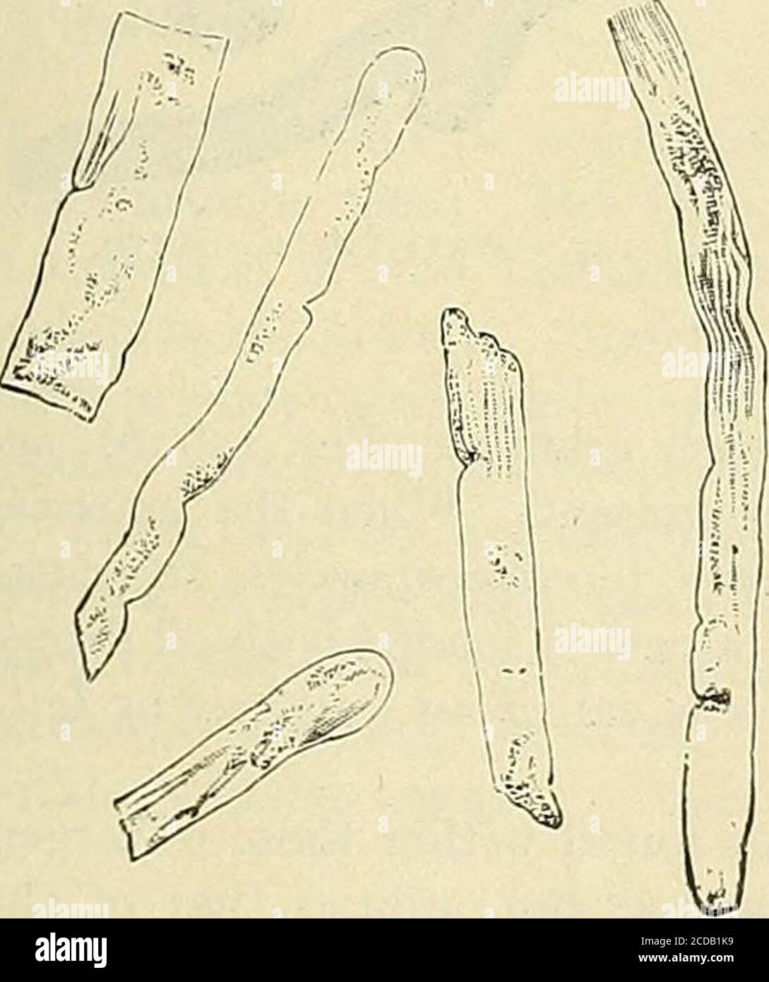 . The practice of medicine; a text-book for practitioners and students, with special reference to diagnosis and treatment . Fig. 121.—Epithelial Fig. 122.—Pus Cast.Casts and GranularFatty Renal CeUs. 123.—Blood Casts—{afterWhiltaker). The basic substance of blood-casts is most probably the fibrin of the blood.If the epithelium be firmly attached to the basement membrane of thetube and remain behind when the cast passes out, or if the tube be entirelybereft of epithelium, then is the cast a hyaline (Fig. 124) or structureless. Stock Photo