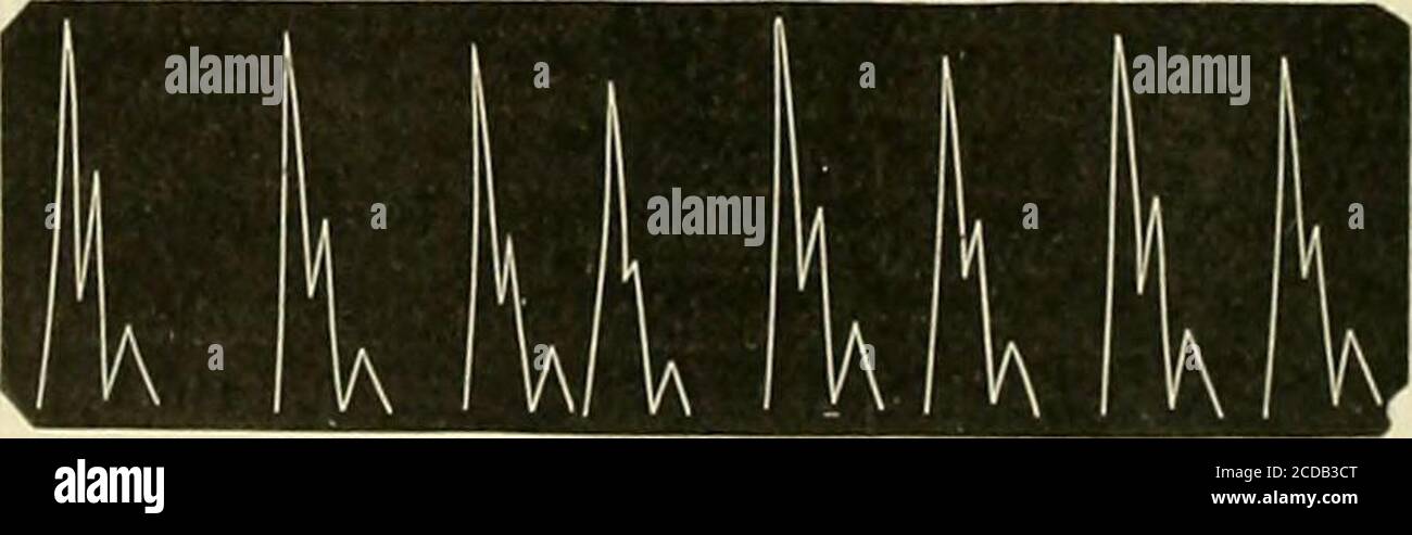 . The practice of medicine; a text-book for practitioners and students, with special reference to diagnosis and treatment . Fig. iisa.—Tracings of Pulse of Aortic Regurgitation. valve segments, and the blood flows backward into the left ventricle duringdiastole. The ventricle, seeking to restore the balance, redoubles its energyand hypertrophies. The blood is thus driven into th» aorta with greatforce, distending the arteries to an extreme fullness, which, however, fallspromptly away, because of the backward flow into the ventricle at the sametime with the forward movement into arteries and ca Stock Photo