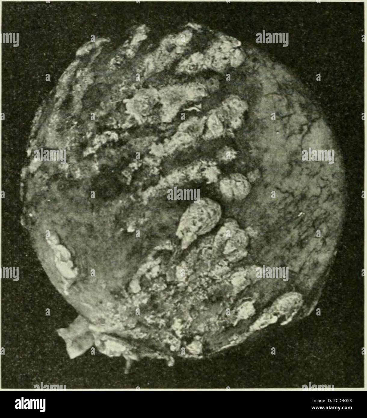 . The Journal of laboratory and clinical medicine . ^ 4, 1921, the animal appeared well. A catheterized specimen ofurine showed erythrocytes and leukocytes, but no albumin or casts. February19, the animal had lost in weight. The right kidney was removed. The cap-sule was adherent opposite eight small whitish scars which on section ap-peared to be healed embolic areas of focal necrosis. Microscopic examinationshowed small areas of interstitial, round-cell infiltration between the tubulesin the cortex, and in the glomeruli and immediately adjacent to them. Themedulla was free from lesions. March Stock Photo