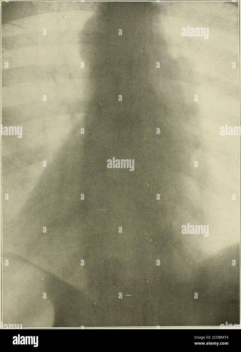 Aortic Shadow . Syphilis : a treatise on etiology, pathology, diagnosis, prognosis ...