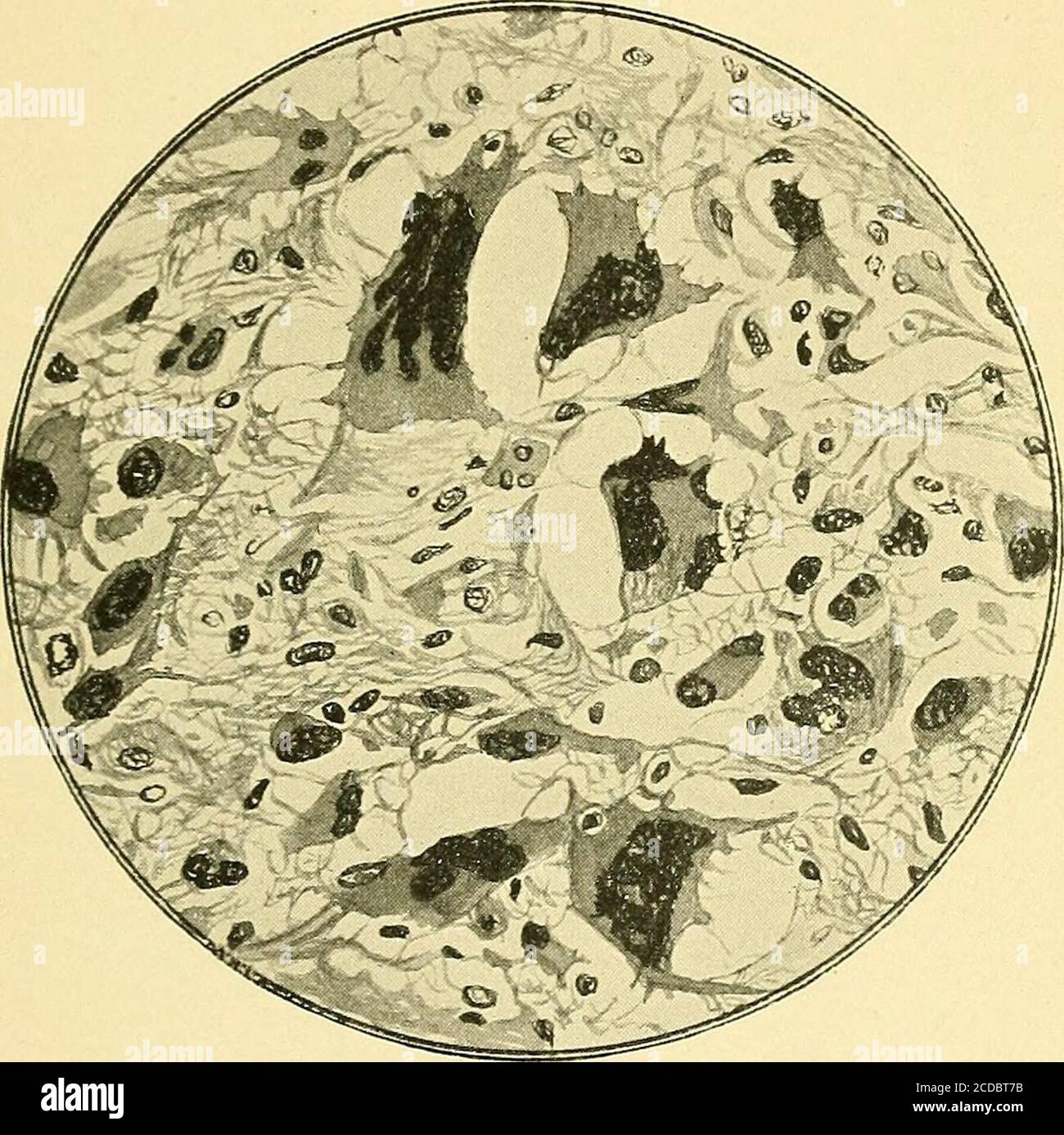 . Some points in the surgery of the brain and its membranes . Fig. 195.—Sketch to show area of brain exfR, Furrow of Rolando ; F^, F^, F^, frontal convolutions. OF TUMOUR OF THE BRAIN 383. Fig. 196.—Microscopic section of frontal tumour.The tumour is a glioma with giant cells. 384 SOME POINTS IN THE SURGERY Stock Photo