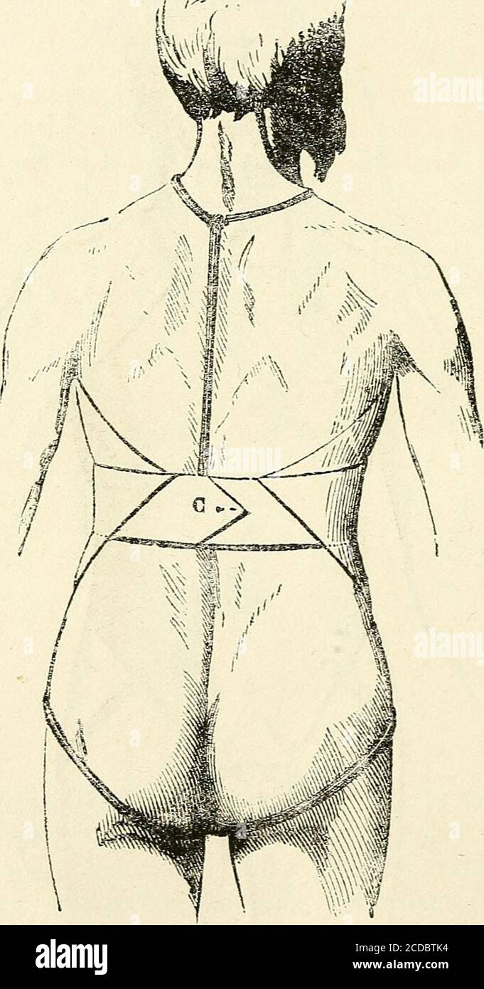 Manuel de petite chirurgie . Fig. 126. B (fig. i26); le sommet du mouchoir  est dirigé en bas, les deuxangles de la base sont conduits horizontalement  en arrière, etnoués ou fixés