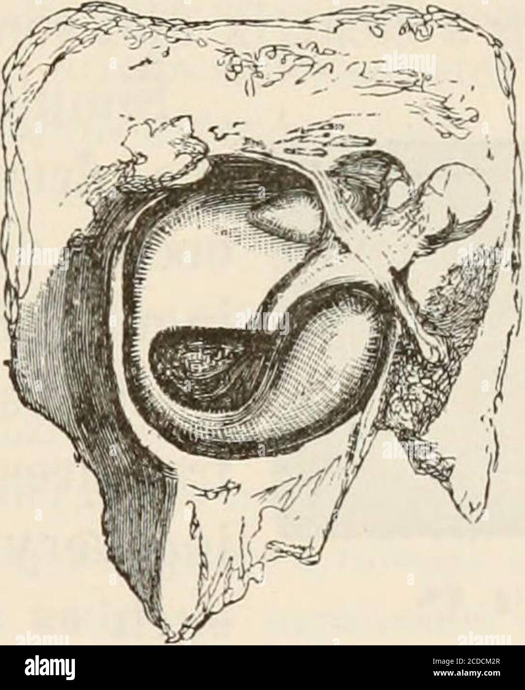 . The pathological anatomy of the ear . Fig. 53. Fig. 51. Rupture of the Drum-membrane, from a blow on the ear. From Toyn-bee, Diseases of the Ear, p. 182. Fig. 52. Rupture of an atrophied Drum-membrane, from violent inflation byYalsal-as method. From Toynbee, Ibid., p. ]83. Fig. 53. Rupture of the Drum-membrane, from a person who was hanged. Seenfrom the tympanum. indirectly from air pressure (explosion, box on theear, diving, and from whooping cough); also, fromfractures of the skull, and from violent concus-sions of the petrous bone. The edges of a rupturefrom a direct wound are generally i Stock Photo