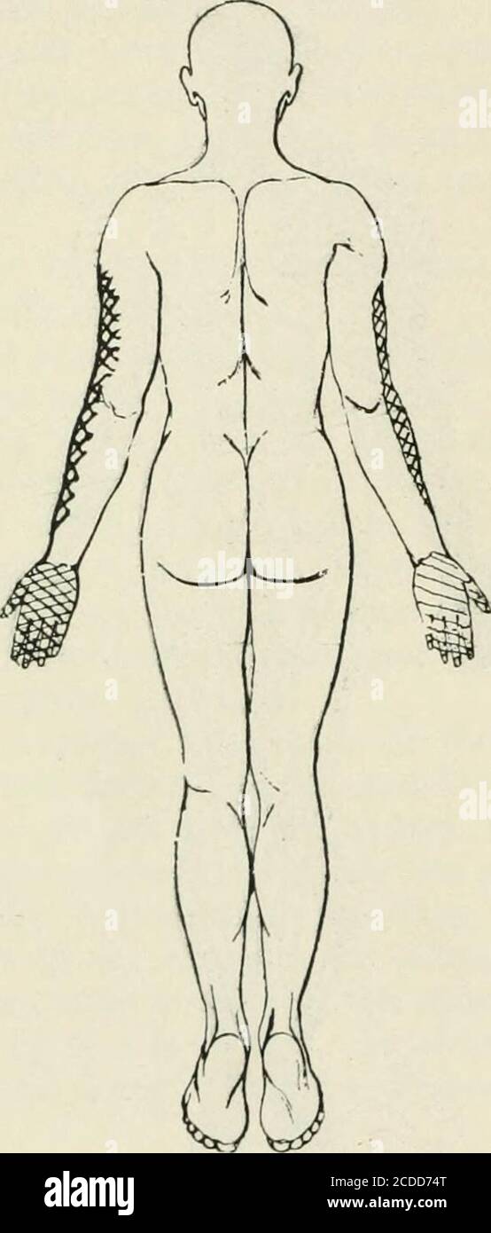. The Journal of nervous and mental disease . at onset or since. No loss of tactile or painsense anywhere. Sense of heat and cold lost, or confused, inirregular area over the right shoulder anteriorly, over rightpectoralis major and over outer half of right arm and forearmanteriorly to a point three inches above wrist. Cannot recog-nize cold with right hand or fingers. Cannot recognize heat orcold with left hand and over a longitudinal strip on posteriorexternal surface of left arm and forearm. (See Fig. 2.) 242 F. W. LANGDON Reflexes.—Pupils do not dilate in darkness or on irritation ofskin o Stock Photo