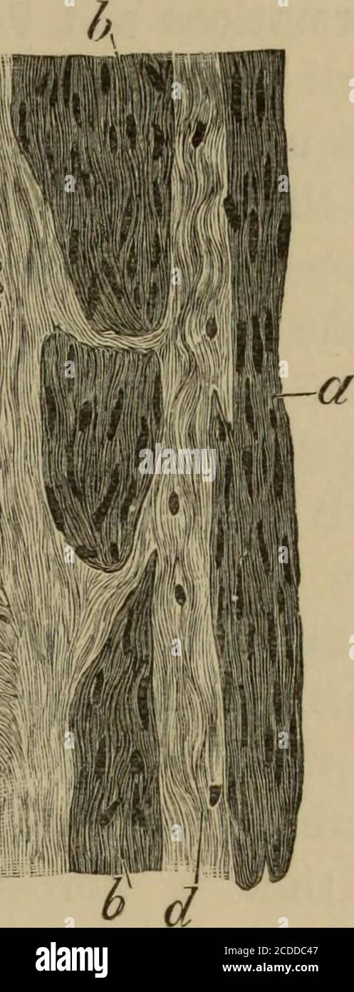 . The elements of pathological histology with special reference to practical methods . &gt; Fig. 157.—Fibro-myoma of the Uterus, x 160. (Hsematoxylhi and eosin.) «and h, Bundles of smooth muscle fibres in longitudinal and oblique section ; c,Bundles of smooth muscle fibres in transverse section, with perfectly homoj,^eneousinterstitial substance; d, Fibrillary connective tissvie ; e, Connective tissue of morehomogeneous character ; /, Transversely-cut muscle fibres, partlj (in the lower half ofthe figure) in a state of mucous degeneration. of round or spindle-shaped cells. Carcinomata are far Stock Photo