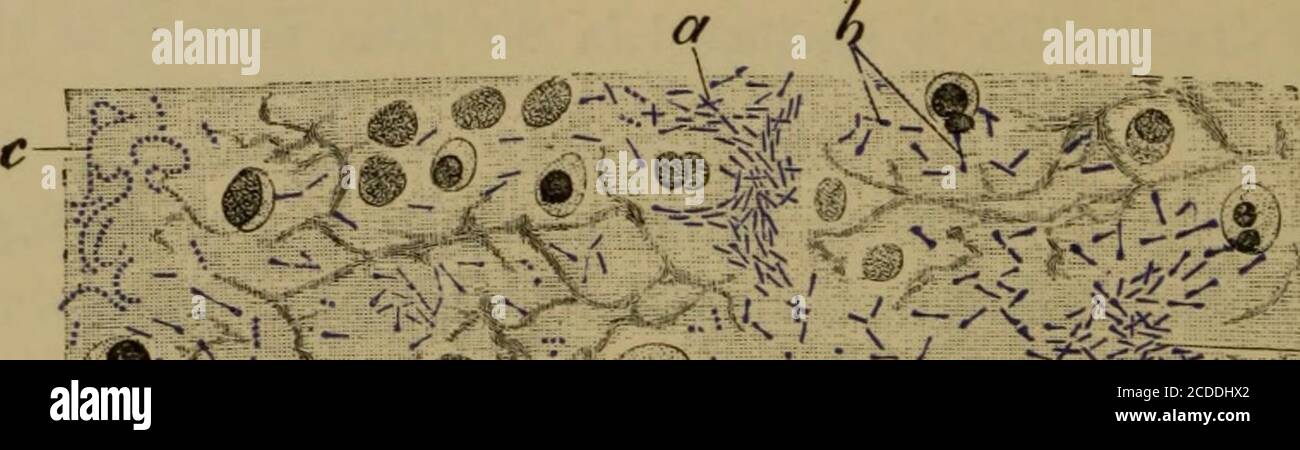 Pharynx diphtheria hi-res stock photography and images - Alamy