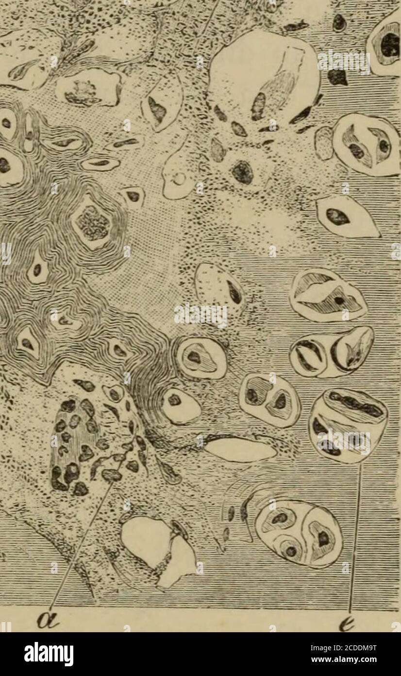 . The elements of pathological histology with special reference to practical methods . •:«^ -^-^ e. Fio. 2G.—OsTEO-CHOXDROMA OF A DIGITAL Phalanx. X 240. (Stained withhjematoxyliu and eosin.) «, Connective tissue resembling bone-marrow; b,Osteoblasts; c, Bone, with young bone-corpuscles; d, Cartilage which had becomecalcified, but was partially deprived of its lime salts by treatment with acid ; e,Uncalcified hyaline cartilage. Mucous degeneration is also sometimes observed in chondromata, inwhich case the interstitial substance is liquefied into a mucinous fluid,with destruction of the cells, Stock Photo