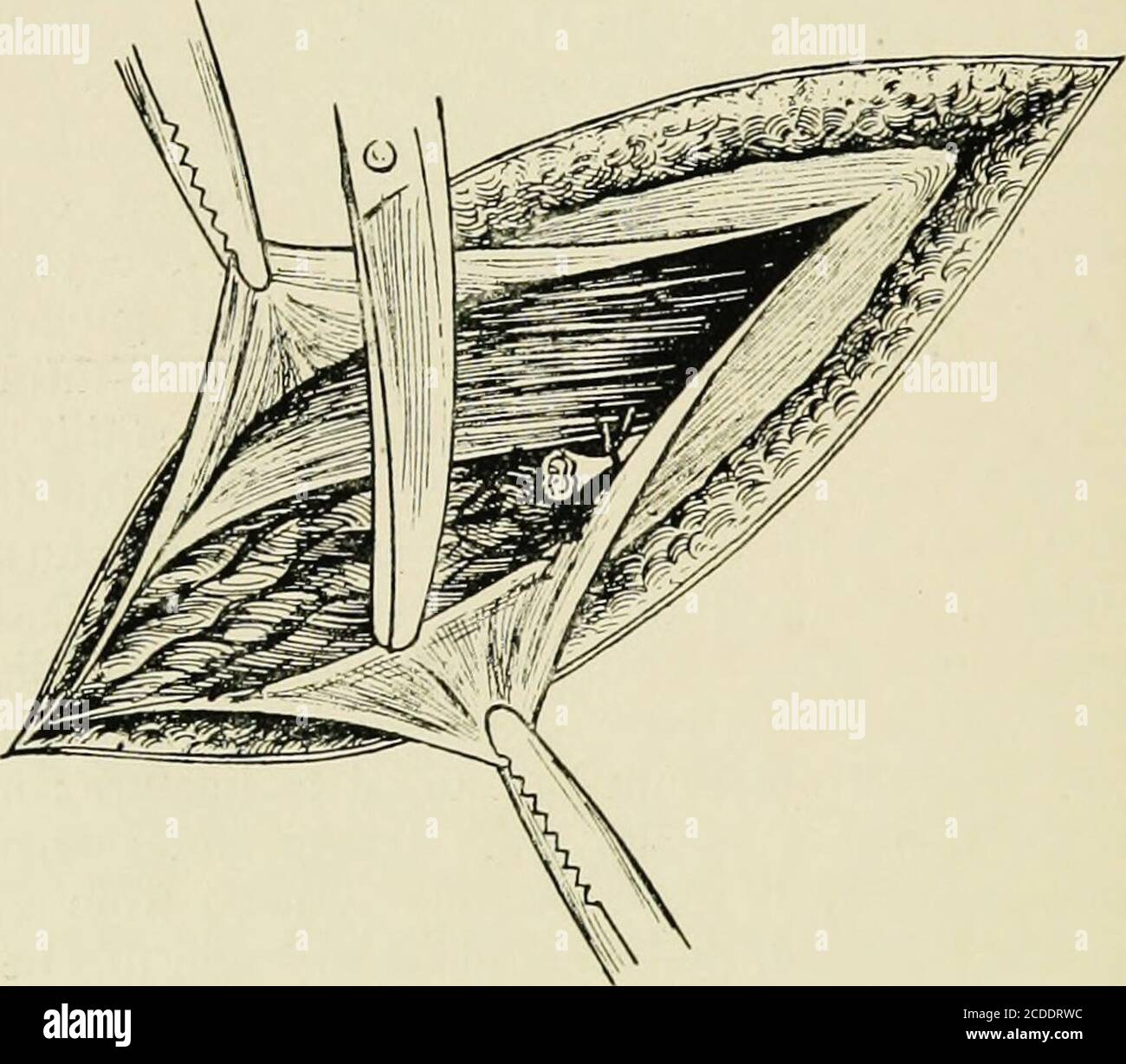 Pick up forceps hires stock photography and images Alamy