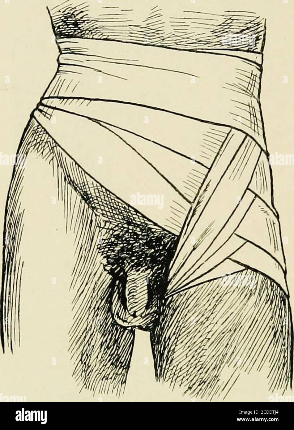 . The practice of anæsthetics . Fig 45.—Spica of thumb. 292 BANDAGING. Fig. 46.—Spica of hip or groin. BANDAGING 293 Stock Photo