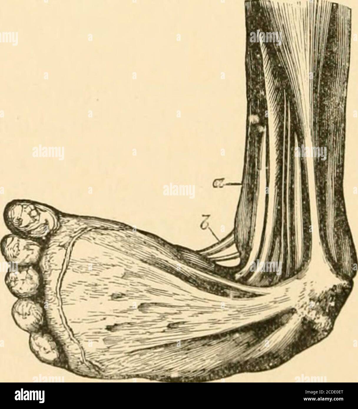 The Surgical Treatment Of The Common Deformities Of Children Fig 49 Dissection Of Equino Varus Club Foot Dorsal View Adams Displacement Of The Internal Cuneiform Bone Thisinclination Inwards Affects More Or Less All