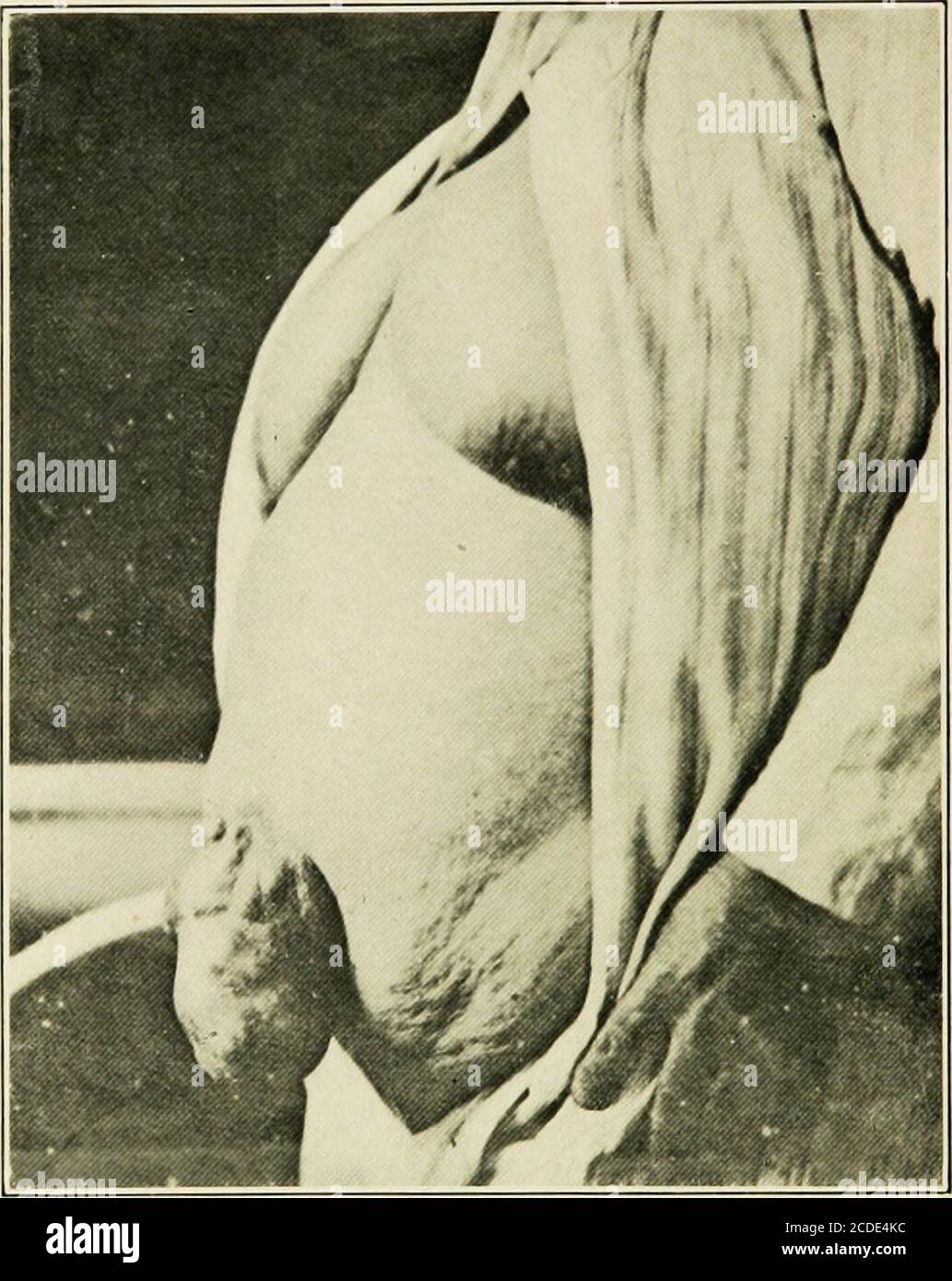 Page 4 Umbilical Hernia High Resolution Stock Photography And Images Alamy