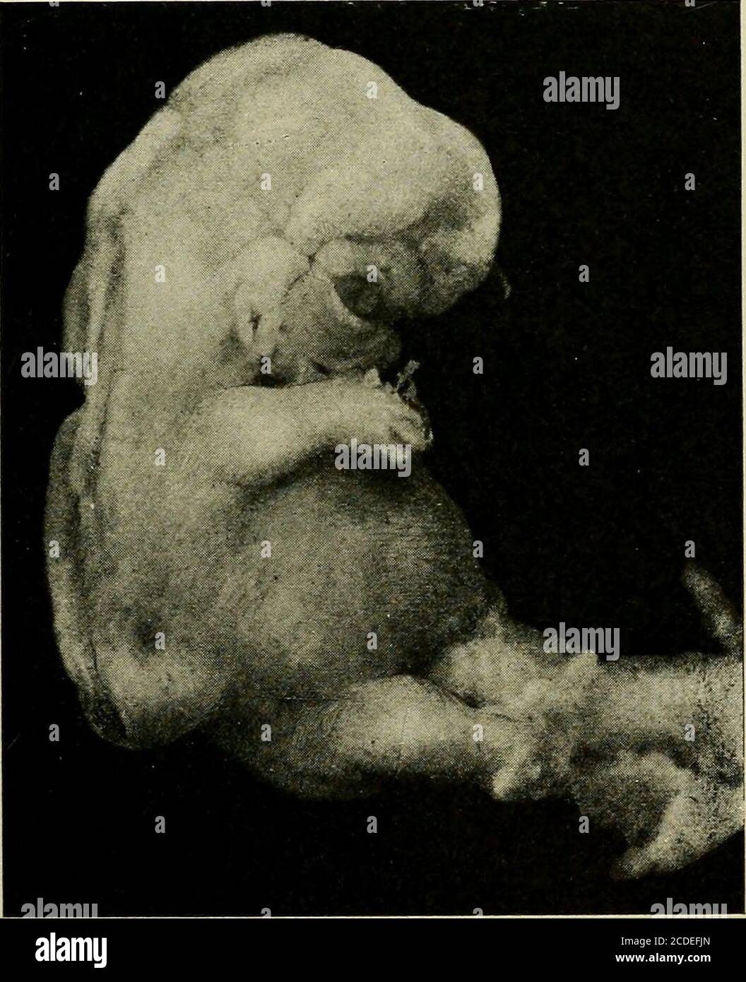 . A study of the causes underlying the origin of human monsters : third contribution to the study of the pathology of human embryos . Fig. 292a b.—Photograph of the embryo lying within the magma,times. X 7 No. i.] ORIGIN OF HUMAN MONSTERS. 285 most of the spinal cord have been destroyed; at one point thecord ramifies through the embryo. In the middle of the em-bryo the aortae and ccelom are sharply defined, but elsewherethe tissues are entirely obscured by numerous round cells. Theepidermis is intact. No. 293. Embryo, C. R., 19 mm. Dr. Lamb, Washington. Dr. Lamb writes: Yesterday I sent you an Stock Photo