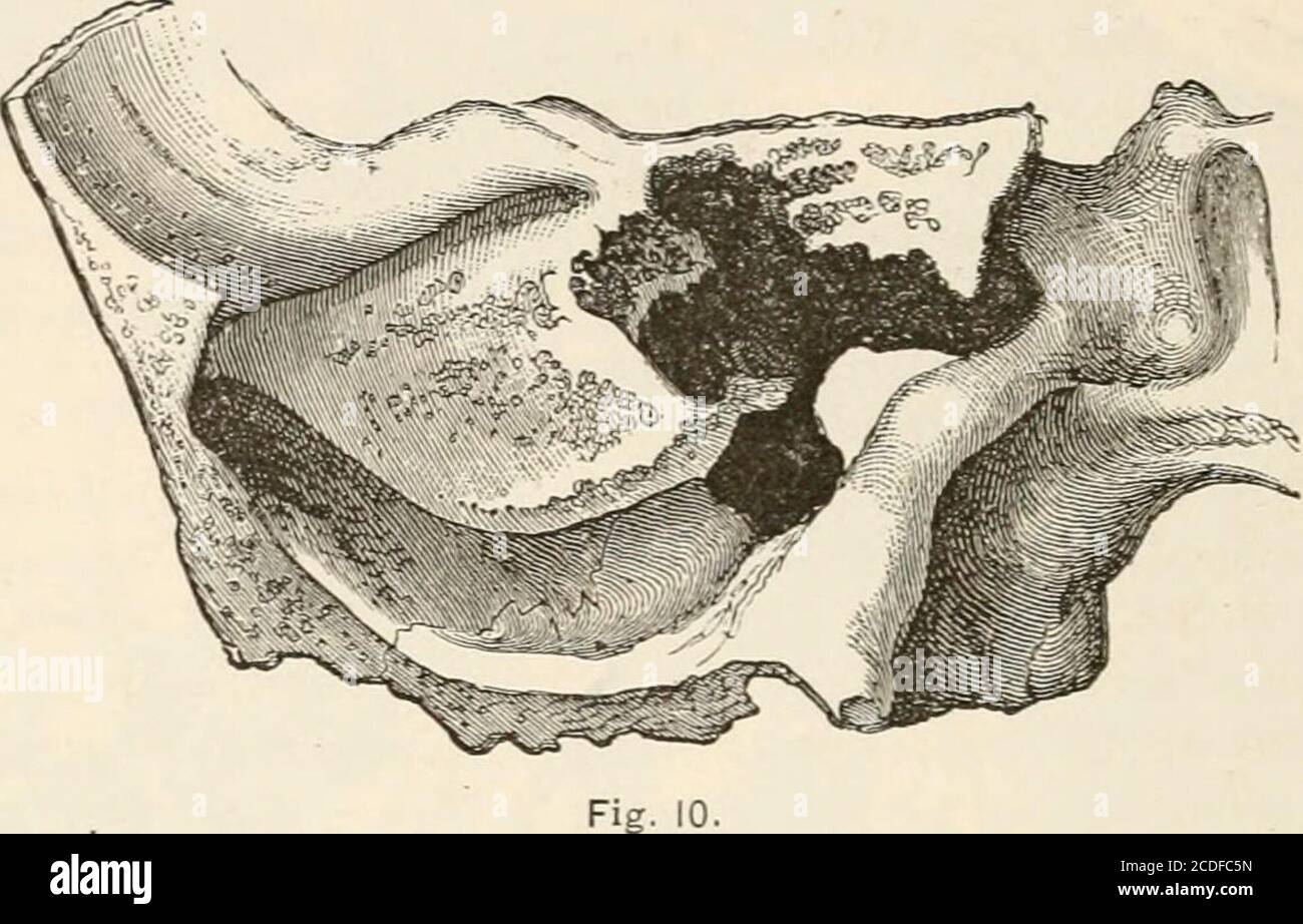 porus acusticus internus