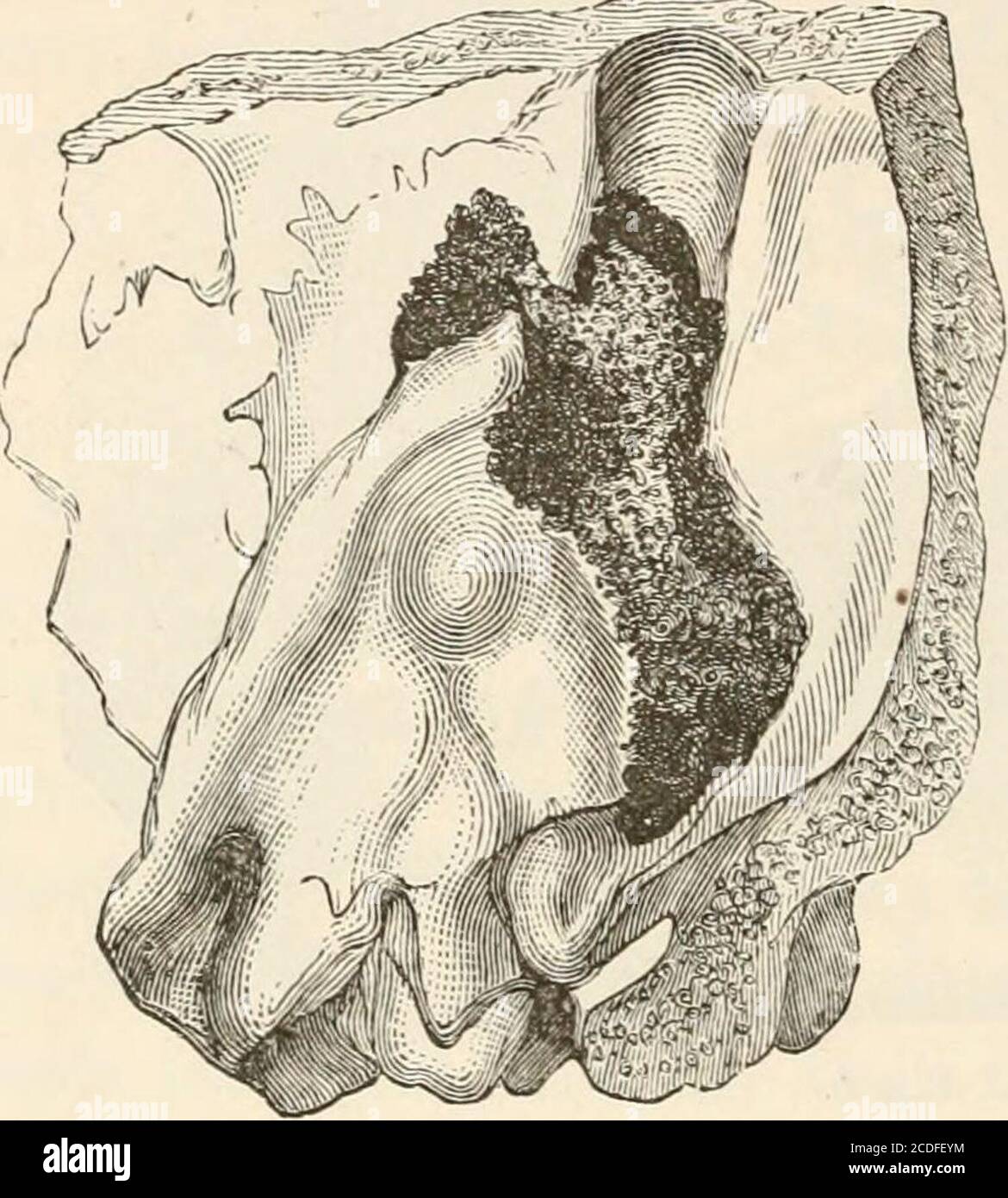 . The pathological anatomy of the ear . h, fiir Phys. Heil-kunde, ix., 1868. AVreden, Petersb. Med. Zeitschr., xvi., 5, S. 61-137.Wendt, Arch, filr Heilkunde ron Wagner, xi., S. 562. 1 Kimmel, Observatio Anat. Patholog. de Cnnali Carotico Carie Syphi-litica Exeso, Lipsiae, 1805, witb an illustration. Boinet, Arch, de Med.,1837. Lavacherie, Bulletin de IAcad, de Med., 1848, vol. vii., p. 789. San- 16 PATHOLOGY OF THE EAR. media, of the large venous sinuses or of the bulbusvenae jugularis. By which channels the extension of the purulentinflammation takes place frequently remains uncertainat the Stock Photo