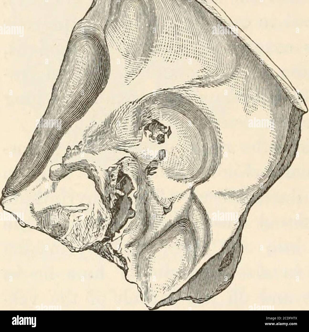 . The pathological anatomy of the ear . , Zeitschi.f. Chir. und Geburtsk. VII. 3. l^bl. — Wolf, Preuss. Vereins-Ztg. 1857.Nos. 35, 36. — Meniere, Article on Bony Sequestra observed in the differ-ent Parts of the Ear. Gaz. Med. de Paris. 1857. No. 33. — Hutchinson,Canstatts Jahresber. 1861. 3. S. 50. — /. 6&gt;w&er, Wien. Med. Halle.1863.— OJe?iiM.s, Medicinske Arch. III. 1. 1866.— Von Troeltsch, Anat.Beitrage zur Lehre von der Ohreneiterung. Arch. f. O. IV. S. 97-142. 1869. — /. Gruher, Zur Casuistik der Schliifen- / ^-^-^ bein-Necrose. M. f. O. 1874. No. 9. (Case ofloss of the whole annulust Stock Photo