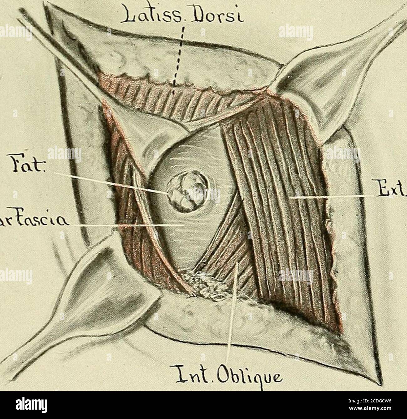 Lumbar Triangle Hernia
