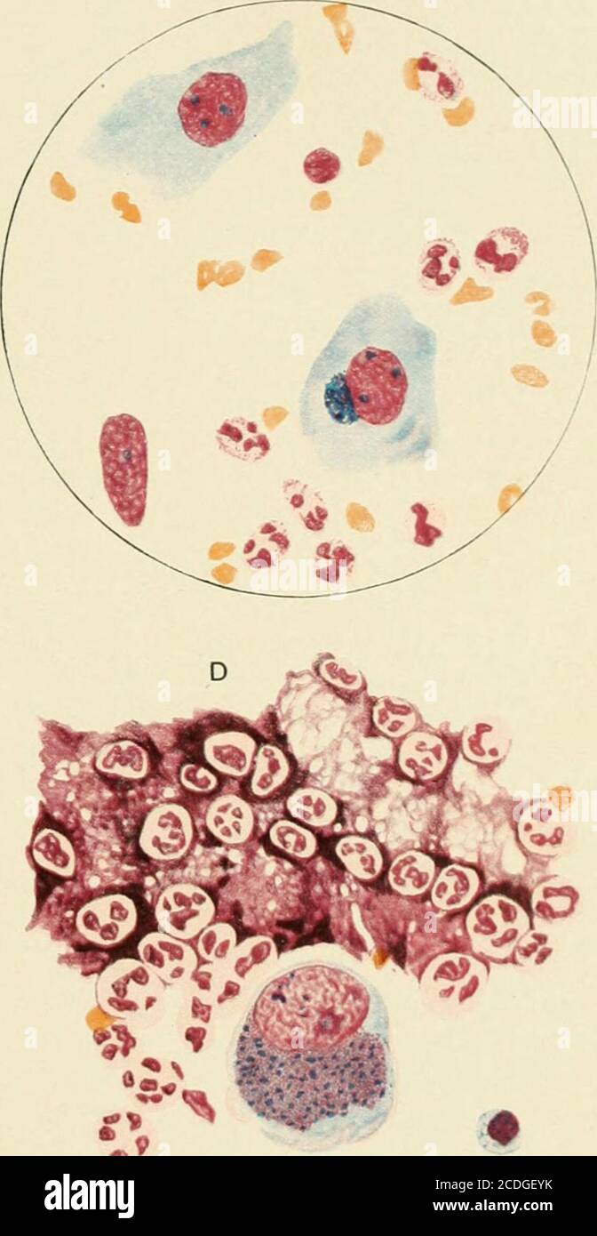 . A treatise on diseases of the eye . ^^^?? The Trachoma Microorganism of Halberstadter andProwazek in various stages. A, early, D, advanced stage. (Drawings by Dr. K. Lindner, Vienna.) TRACHOMA 221 pushed to one side and flattened. Eventually the protoplasm of the cellgives way at some point and the contents become scattered (Fig. 137, 8). Bodies that cannot be differentiated from the trachoma bodies ofProwazek have been found in non-gonorrheic ophthalmia neonatorum(Schmeichler/ Heymann^). Erdmann^ has found similar bodies inchronic conjunctivitis and in vernal catarrh. It is not proved that Stock Photo