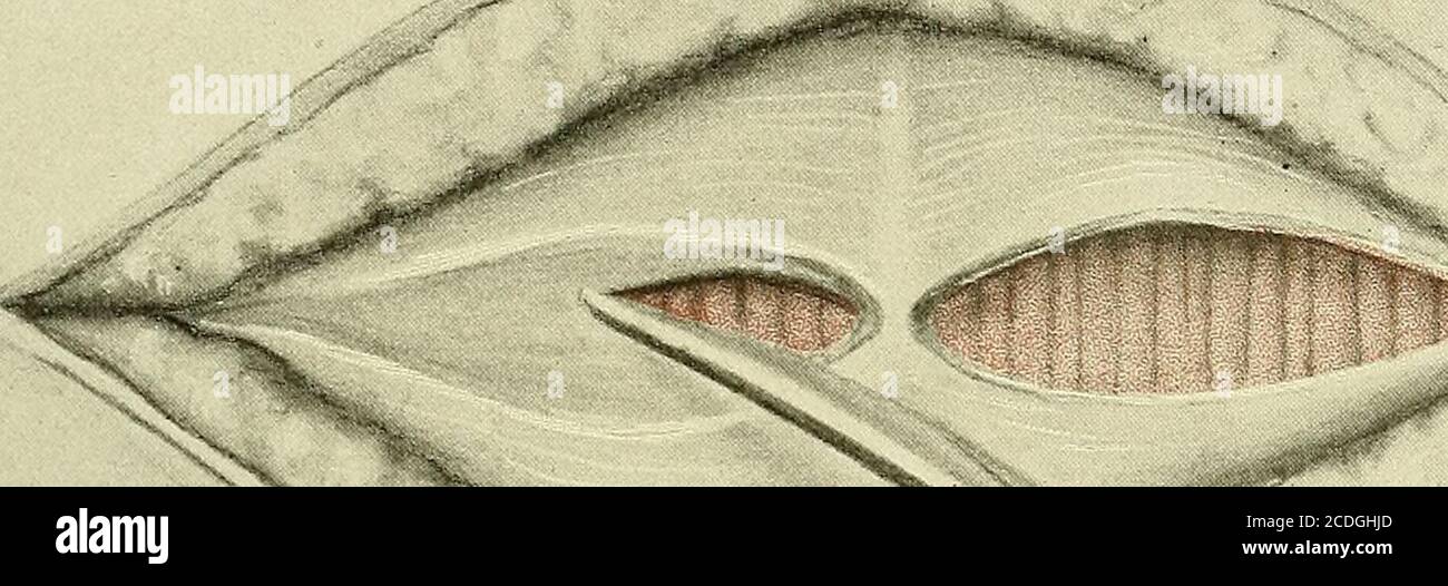 Pfannenstiel incision hi-res stock photography and images - Alamy