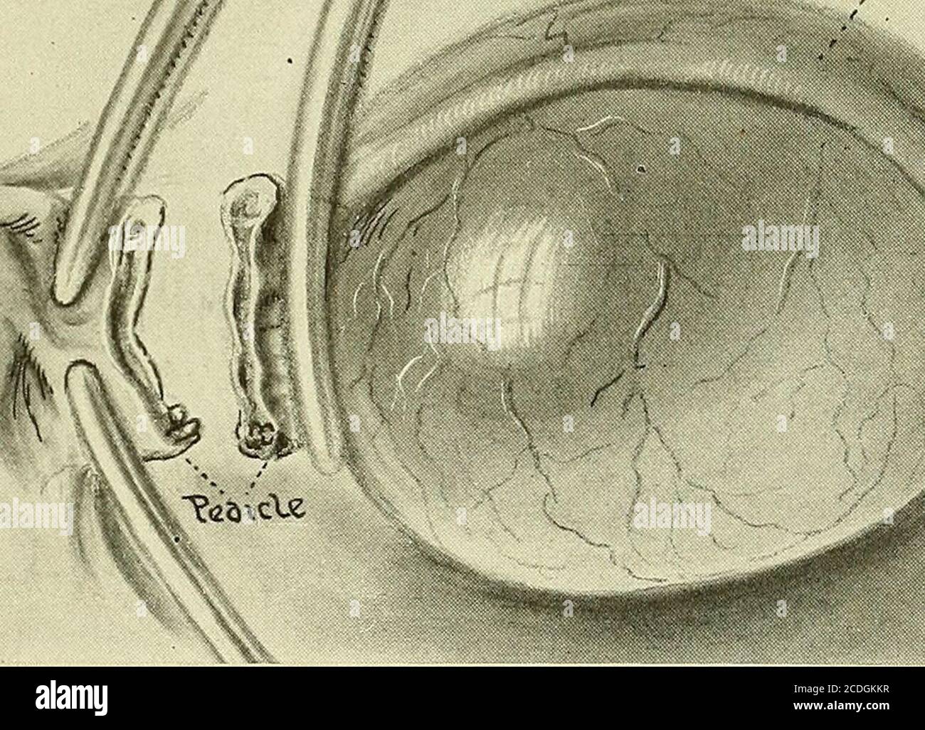 . Gynecology . If Wp.G rc^ts. V Fig. 418.—Salpingooophorectomy