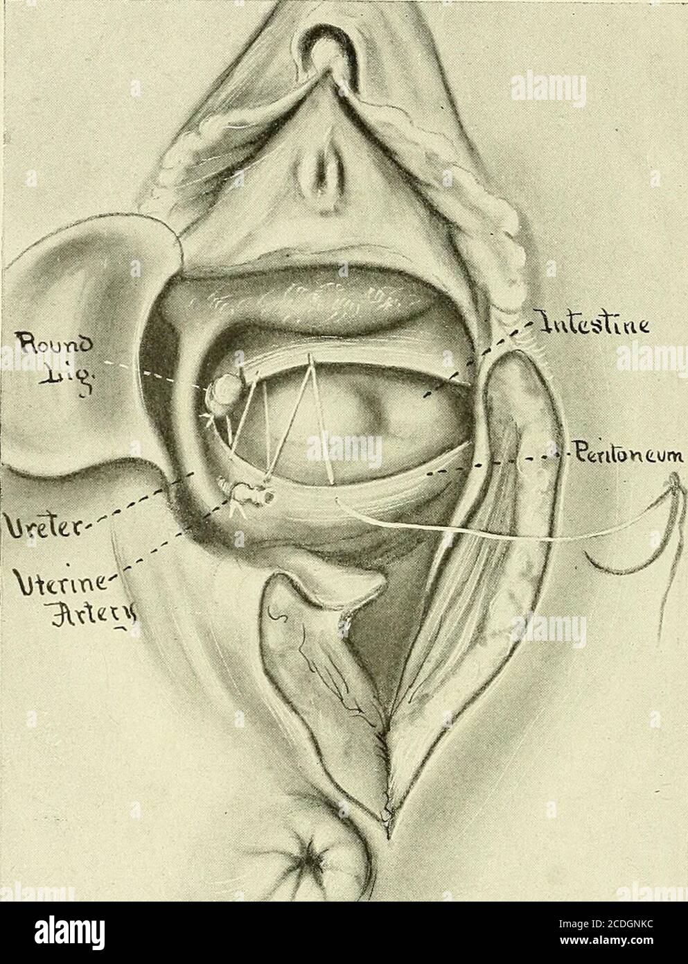 . Gynecology : . of the uterus has been delivered. The broad ligament of the left side is about to be tied and cut. The parametrial tissue is excised as far away from the uterus as possible,there being some bleeding from the hemorrhoidal vessels that run to theuterosacral ligaments. (5) Removal of Uterus and Adnexa.—The fundus of the uterus is deliveredthrough the opening into the uterovesical pouch. This is accomplishedby passing the forefinger of the left hand into the pouch of Douglas andanteflexing the fundus by pressure from behind. The fundus is seized withstrong volsella and drawn sharp Stock Photo