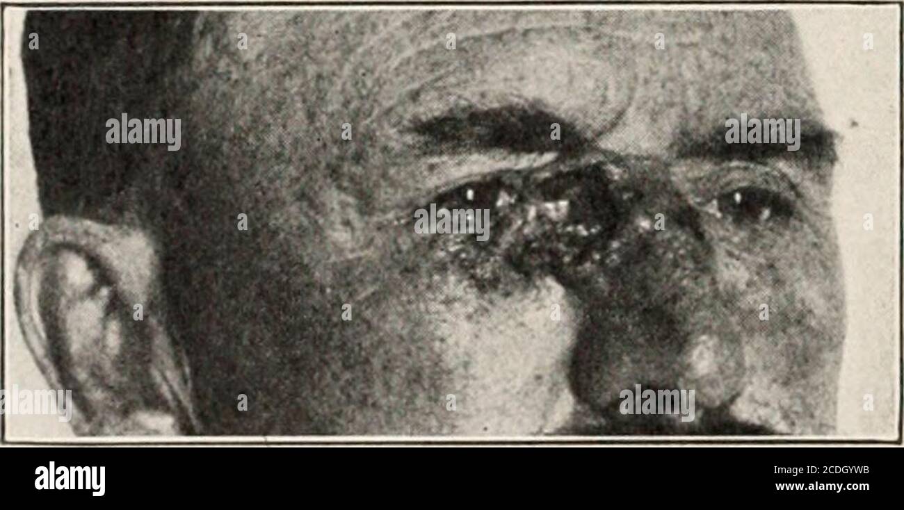 . A treatise on diseases of the eye . olic acid. If the cyst wall isnot changed in character, theopening into it closes and thecyst refills. Mahgnant Tumors. — Carci-noma, in the form of skincancer or epithelioma, is notof infrequent occurrence. Itis peculiar to advanced adult Epithelioma of inner canthus. (Photograph by life (Fig 122). The growtll Geo. s. Dixon.) appears at or near the margin of the lid, in the form of asmall elevation, the apex of Avhich at first becomes scaly, and maysoon be covered by a light crust. The growth may remain in thisstate for years, the crust becoming detached Stock Photo