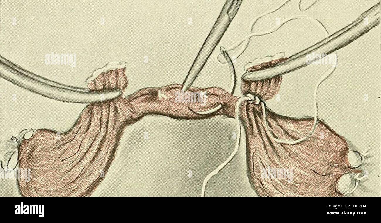 . Gynecology : . i:?.Gr^ Fig. 379.—Supravaginal Hysterectomy.The uterines of the right side are about to be tied. The secondary defense clamp has beenapplied to the ends of the vessels. When the ligature has been tied the lower clamp is removed. Asecond tie is then made for extra safety. 720 GYNECOLOGY Beginning on the right, the round and infundibulopelvic ligaments, whichhave been tied so as to meet each other at an angle, are grasped with clamps.. Fig. 380.—Supravaginal Hysterectomy.The uterine body has been amputated. The lips of the cervical stump have been closed by twointerrupted sutu Stock Photo