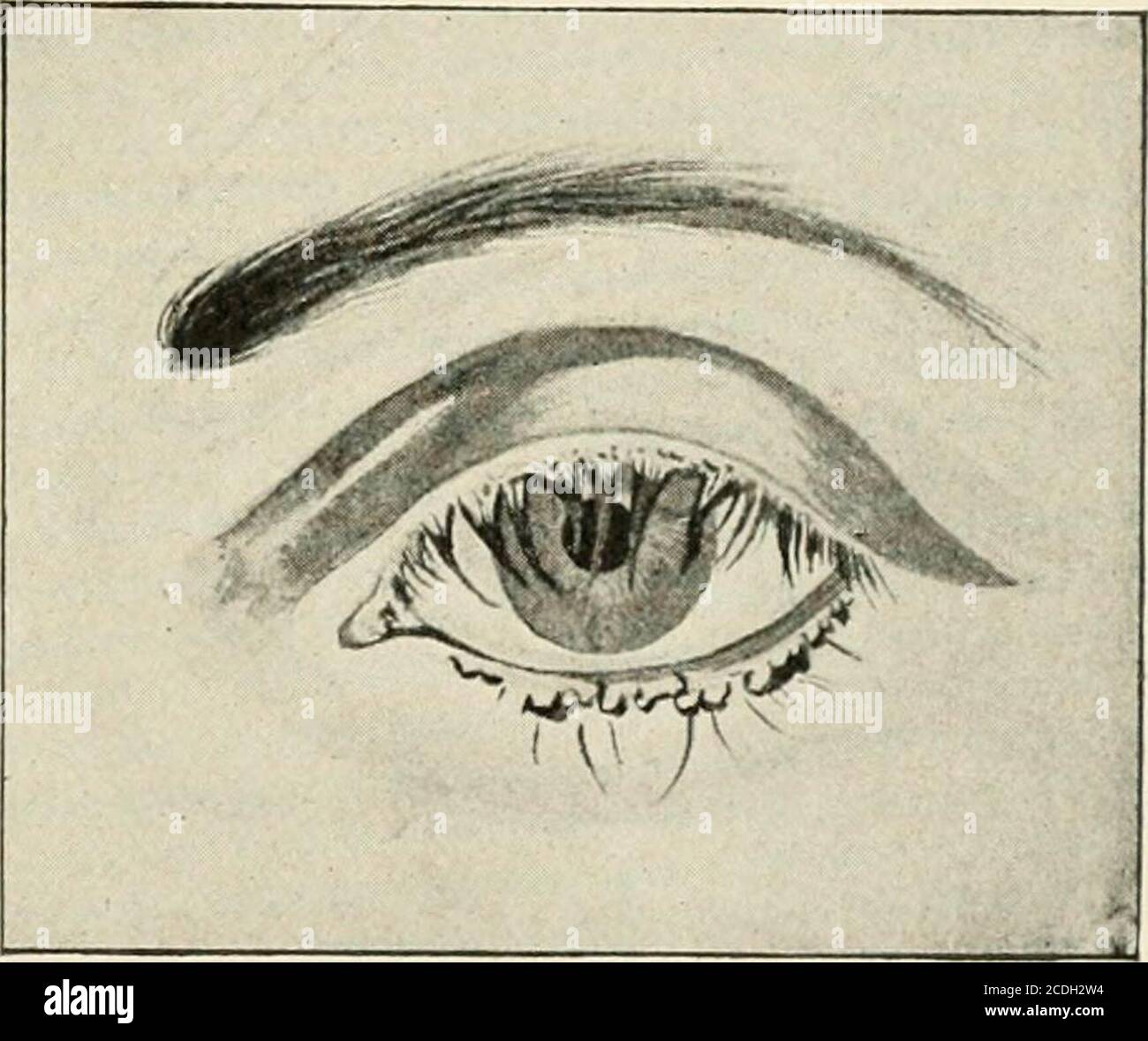 A Treatise On Diseases Of The Eye By The Formation Of Small Pustules Which Are Pierced At Theirapices By An Eyelash The Margins Of The Lids Are Slightly Hyperemicand Are A Treatise On Diseases Of The Eye By The Formation Of Small Pustules Which Are Pierced At Theirapices By An Eyelash The Margins Of The Lids Are Slightly Hyperemicand Are