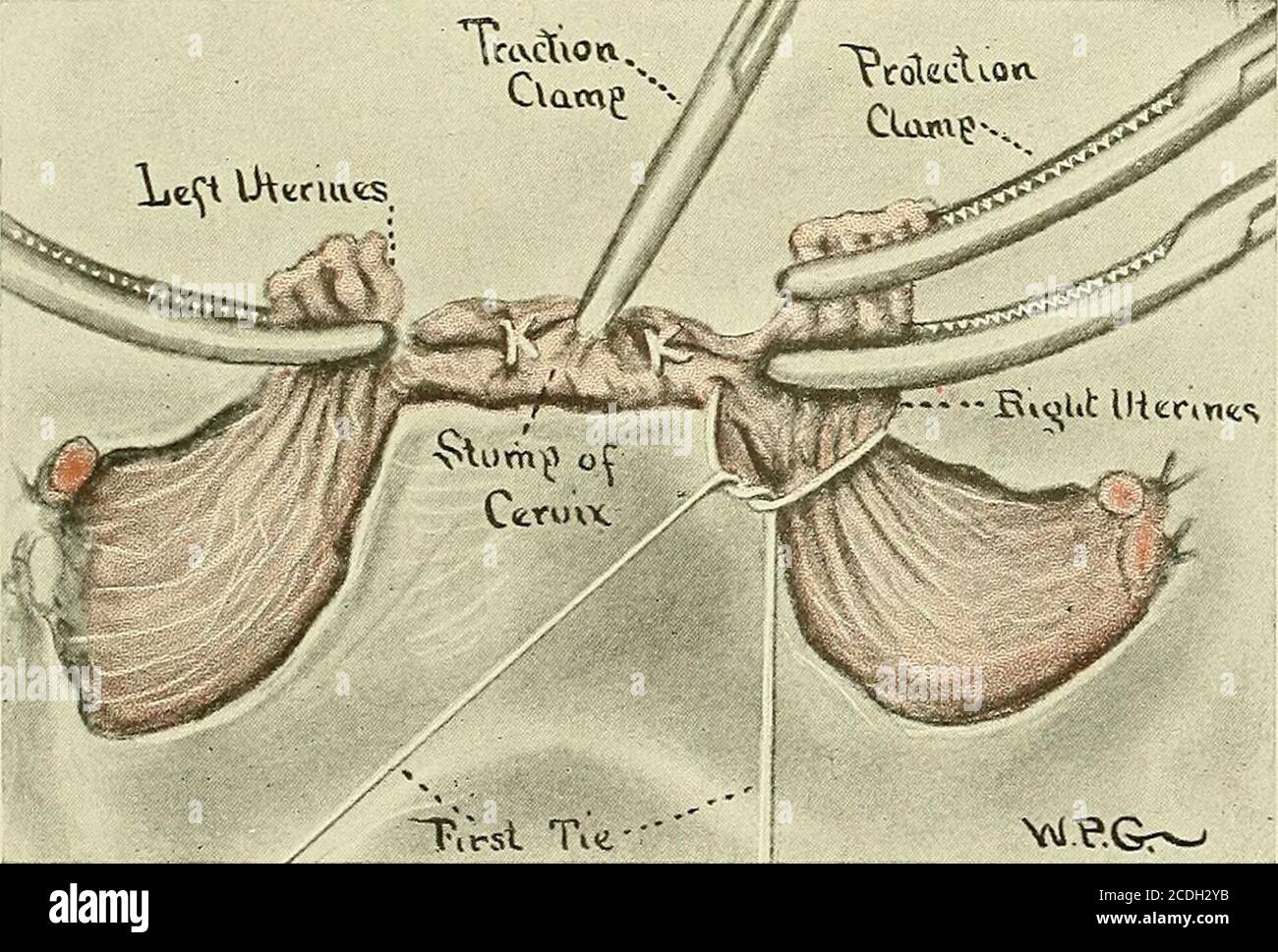 Cervical incision hires stock photography and images Alamy