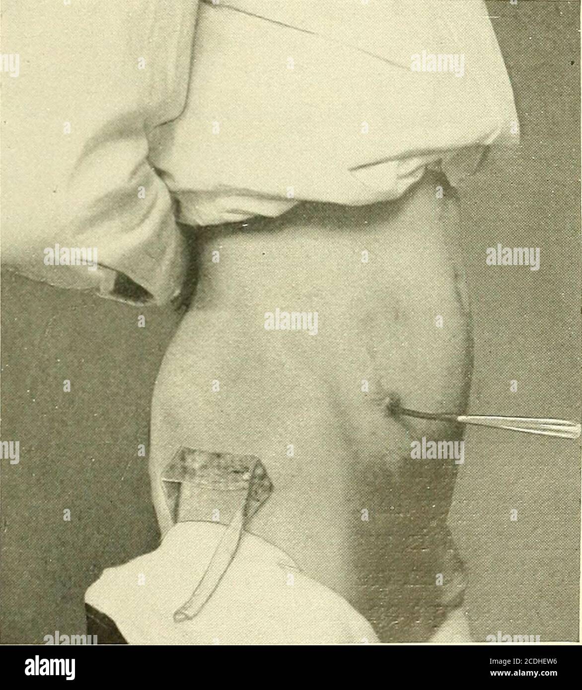 Appendix operation hi-res stock photography and images - Alamy