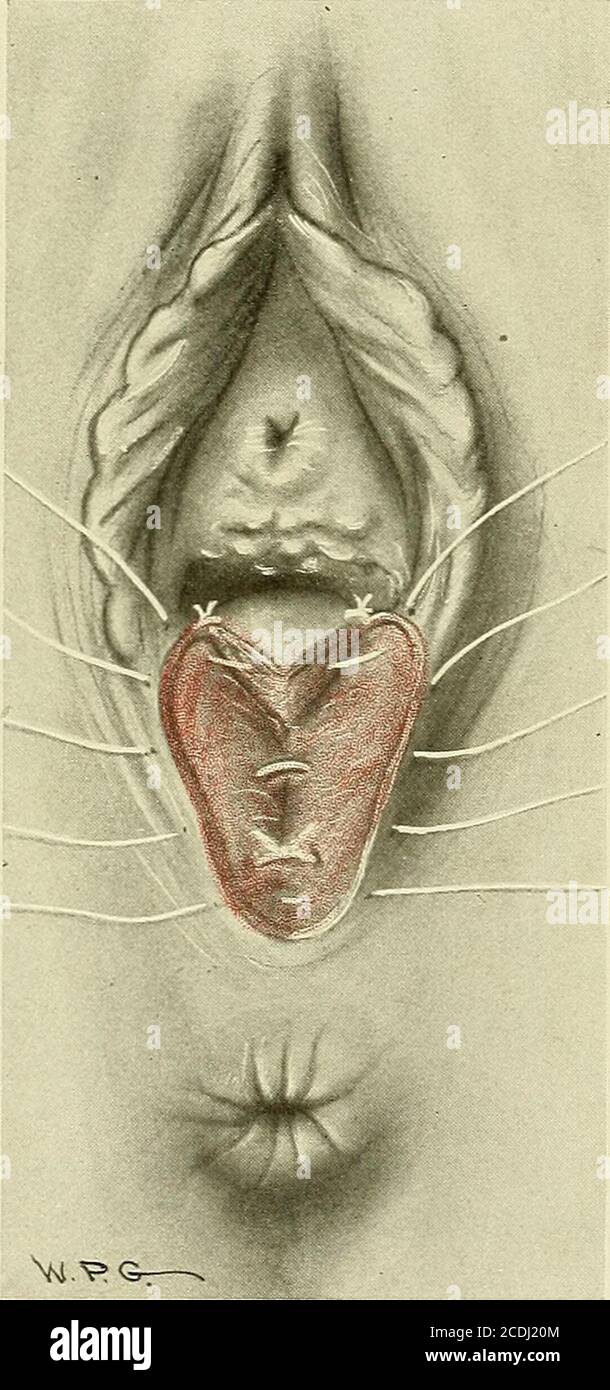 Stitched Up Vagina Stitched Up Vagina