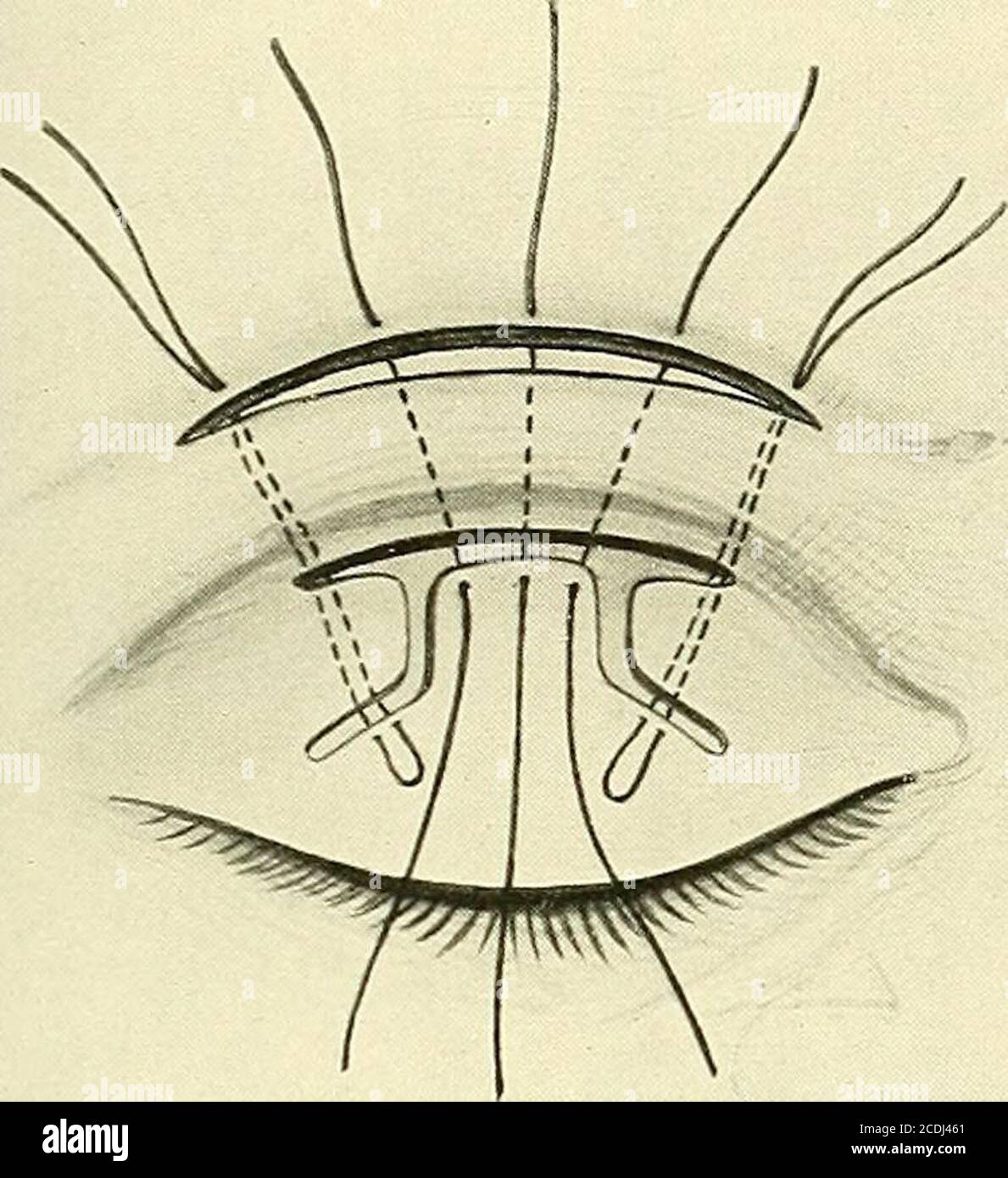 . Surgery, its principles and practice . Fig. 479.—Ptosis (from a ...