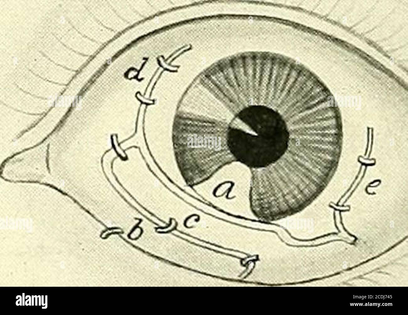 . Surgery, its principles and practice . Fig. 465.—Teales Operation for Symblepharon.The symblepharon is detached at a and removed. Two conjunctival flaps, b and c, are formed and turned to cover the denuded surface of the eyeball and of the inner side of the lid.junctival gaps are closed by sutures, d and e. The con- are as valuable as the systematic breaking up of adhesions several times aday with a probe, associated with rigorous local antisepsis. Operations for Symblepharon.—If in spite of these precautions asymblepharon forms, after all inflammatory symptoms have subsided^an attempt must Stock Photo