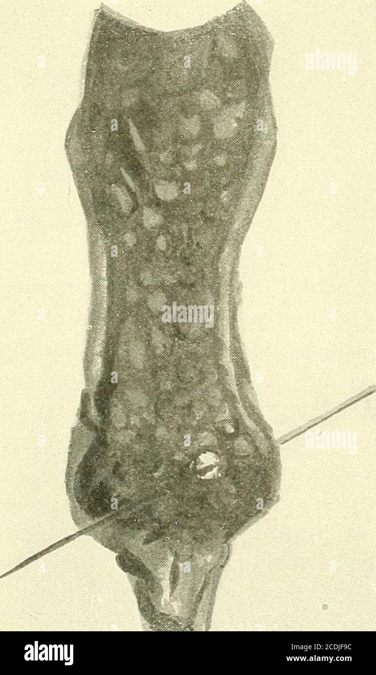 Surgery Its Principles And Practice Careful Examination As The Periappen Dical Tissues Become Involved And The Quantity Of Infective Materialincreases The Tumor Becomes More Pronounced And Often Attains Con Siderable Size