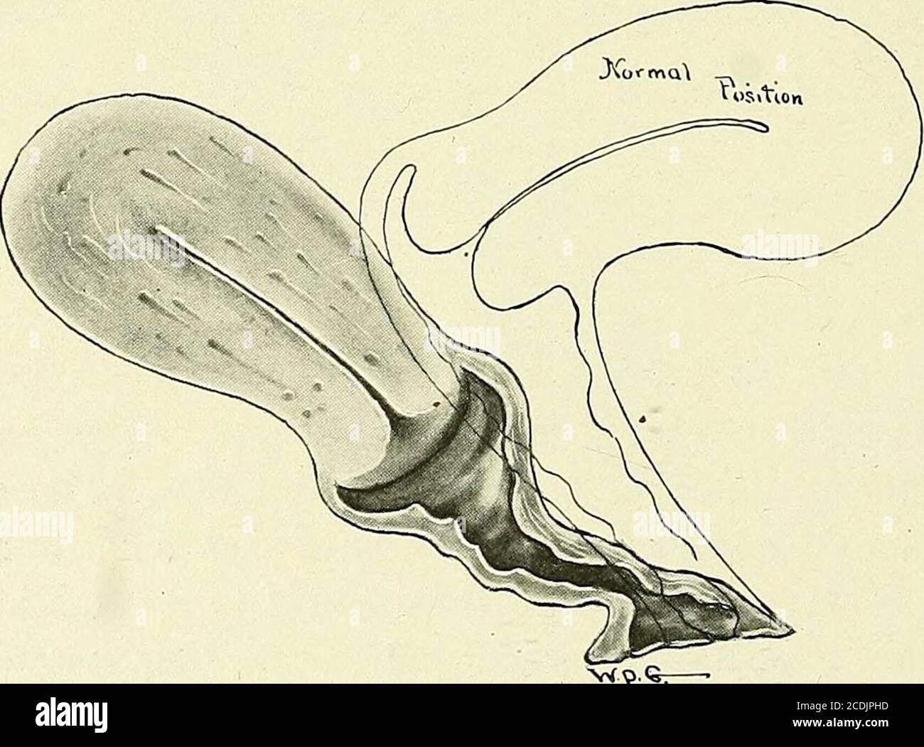 Gynecology : . Fig. 191.—Anteflexion with Retrocession.The whole uterus  sags back toward the sacrum. pressure from behind of a tumor situated in  the posterior culdesac, or by ab-normal attachment of the