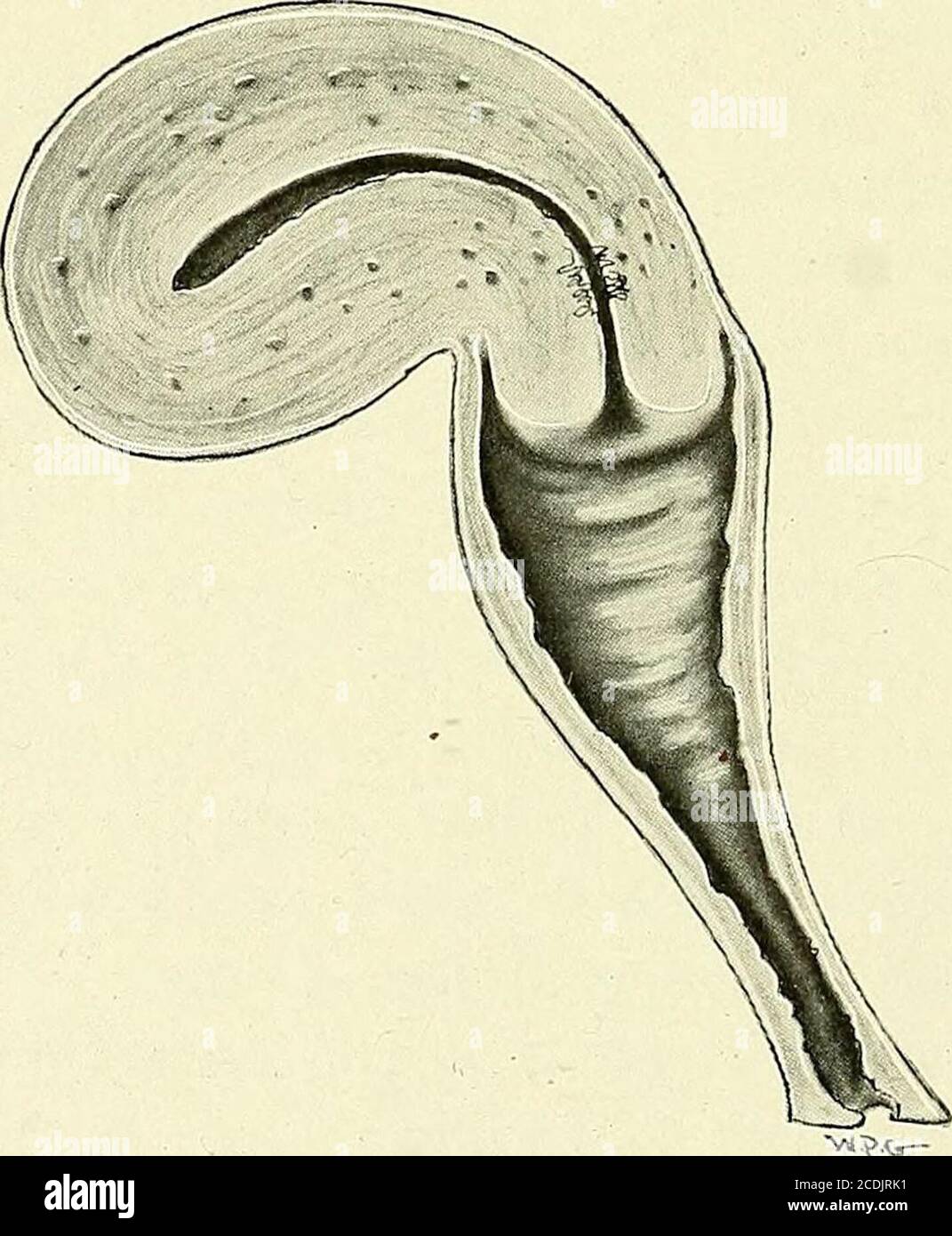 . Gynecology : . Fig. 187.—Retroversion. Second Degree. said to be in ...