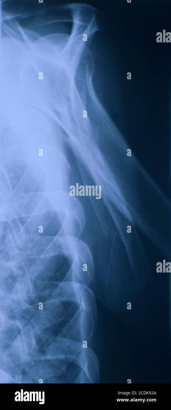 x ray of scapula fracture Stock Photo Alamy