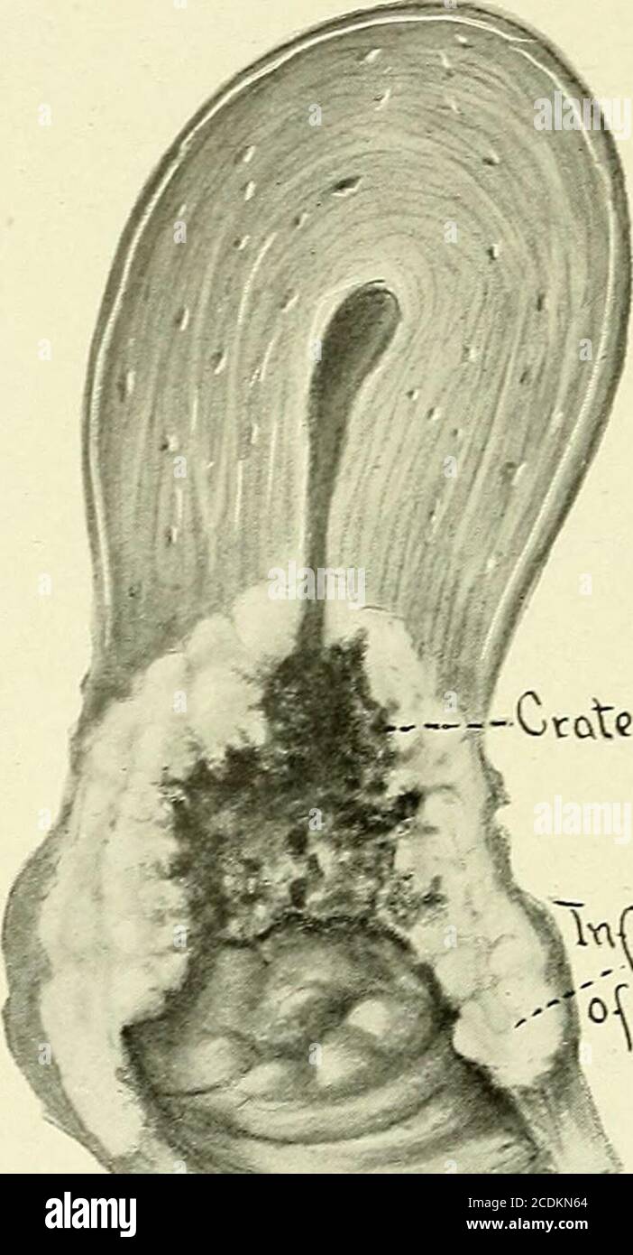 . Gynecology . rtance of curetage for diagnosis, as this growth could