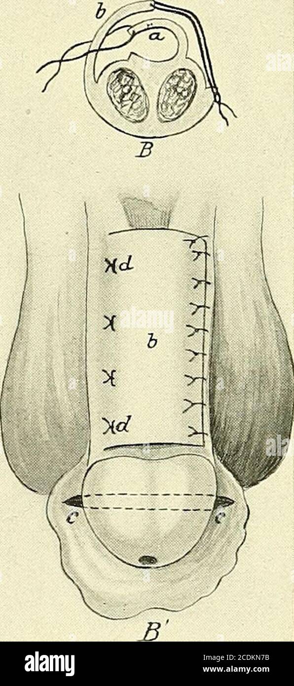 foreskin restored Surgery, its principles and practice . Fig. 284.—Thierschs Operation for  Penile Epispadias, the Glandular Urethra having BEEN Restored. the region  of the scrotum. If there is a redundant foreskin, the pre-putial