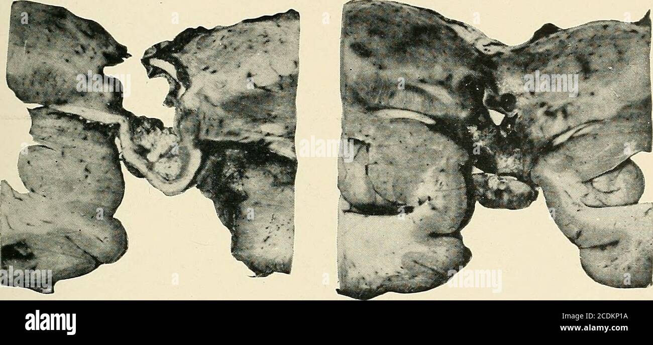 . Bulletin of the Massachusetts Department of Mental Diseases . * J*&gt; Plates 4 and 5. — On the left the section strikes through the anterior end of the thalamus.The columnae fornicis lie lower on both sides, while the crurae assume a dorsal position.Their attachment to the corpus callosum has been torn. On the right, the thalamus ex-hibits differentiation into the nucleus anterior, and the nucleus lateralis and the nucleusamygdalse appear within the temporal lobe. The third ventricle is increased in size, irregularin outline and almost completely replaced by the cyst. There is a free upper Stock Photo