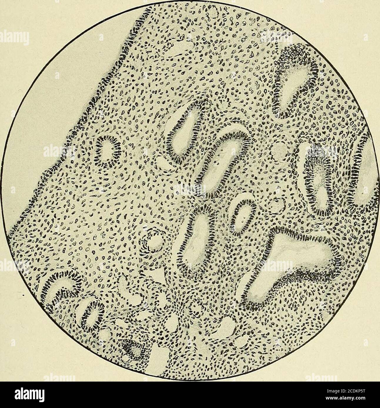 . Gynecology : . milar to that of the cervical canal, where the polyp originated.The stroma consists of connective tissue with a few muscle bundles in it. The cervical polyp represents a hypertrophy of the mucous membrane ofthe endocervix and contains all the elements of that structure. It usually hasa slender pedicle, so that the polyp can easily be plucked off. Sometimes the NEW GROWTHS 333 polyp is sessile, with a broad base. These growths never reach a large size andare more often multiple than single. They are of a bright red or purple color,and can usually be felt by the examining finger Stock Photo