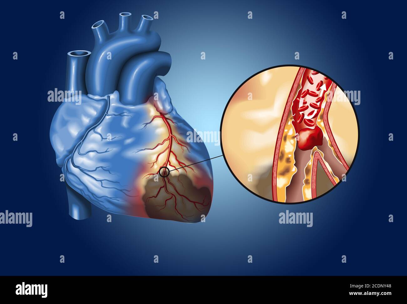 Plaque in coronary artery, blood clot (thrombus) breaking off and blocking blood flow (cardiac infarction) Stock Photo