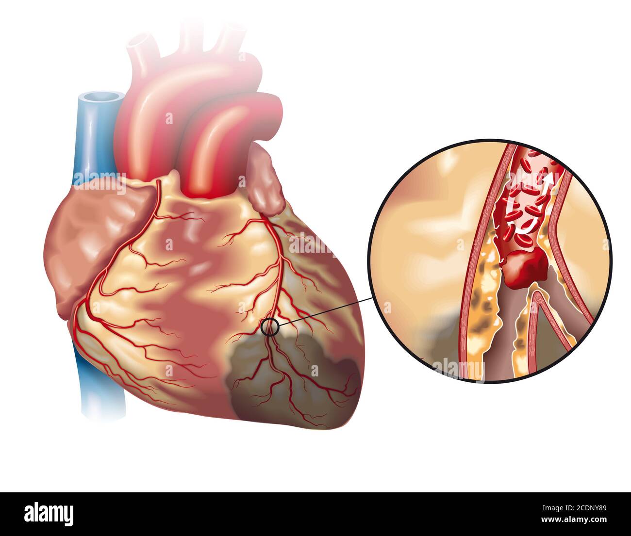 Illustration showing healthy heart (small) and plaque in coronary artery, blood clot (thrombus) breaking off and blocking blood flow (cardiac infarcti Stock Photo