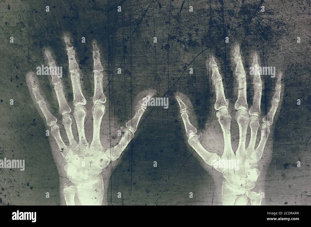 X-ray image of two hands, photomontage trimmed on old and rotten. Stock Photo