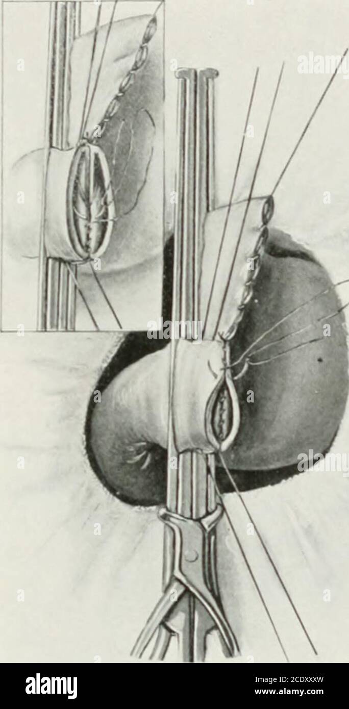 polya gastrectomy