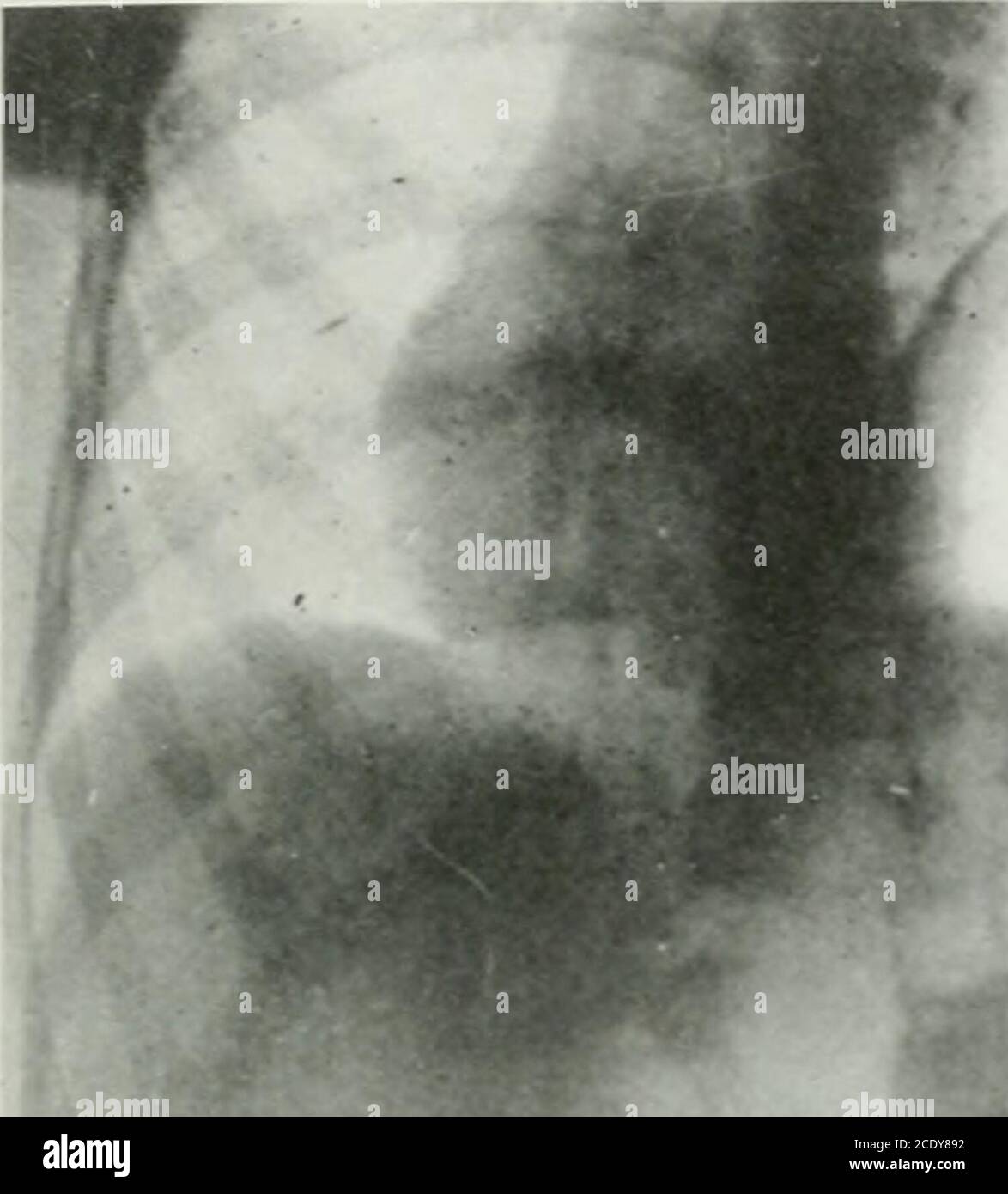 . Annals of surgery . of the left chest is tympanitic, and there is a dull-ness which varies with position of the body and with taking of food andliquid. This shifting dullness of the partly filled stomach may be mistakenfor pyopneumothorax, as in one of our cases. Succussion if obtained mustbe located in the pleura or stomach, and the diagnosis cleared by the X-ray. The chief confusion in diagnosis will be with diaphragmatic hernia.As both conditions may be congenital, and both exist for a long time withoutmanifest symptoms, it is often impossible to distinguish between the twoconditions with Stock Photo