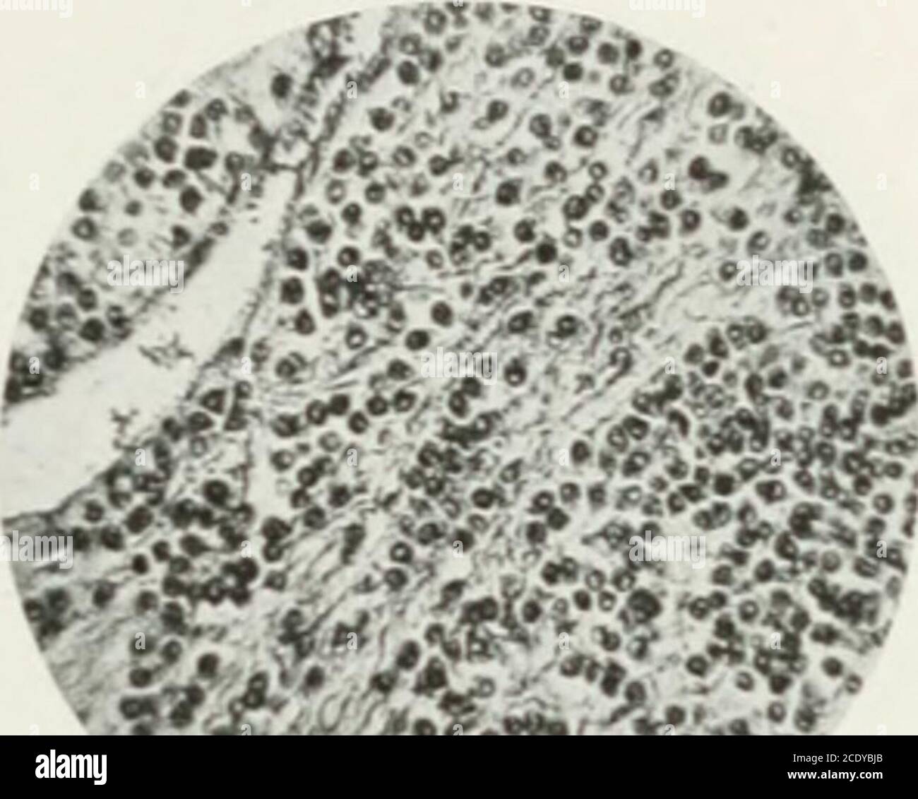 . Annals of surgery . MULTIPLE MYELOMA OF THE PLASMA-CELL TYPE round nuclei was somewhat condensed at the periphery, but coarse, irregular, chro-matic clumps were scattered through the nuclear body. A few cells containedtwo nuclei. The cellular cytoplasm was slightly cloudy but almost smooth andgenerally basophilic; with methylene blue-eosin and with Giemsa stain, many cellswere shown to possess neutrophilic and a few. eosinophilic cytoplasm. In short,the tumor elements somewhat resembled plasma cells. There were, however,certain differences. None of the tumor cells had the pale perinuclear ha Stock Photo