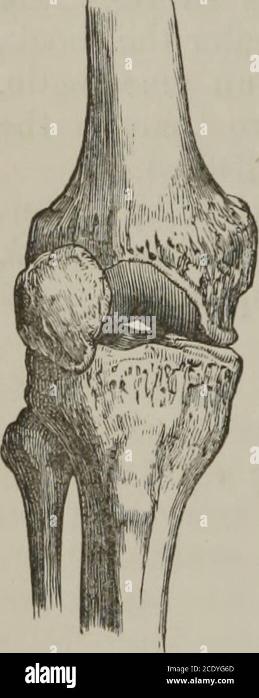 A practical treatise on fractures and dislocations . evidently