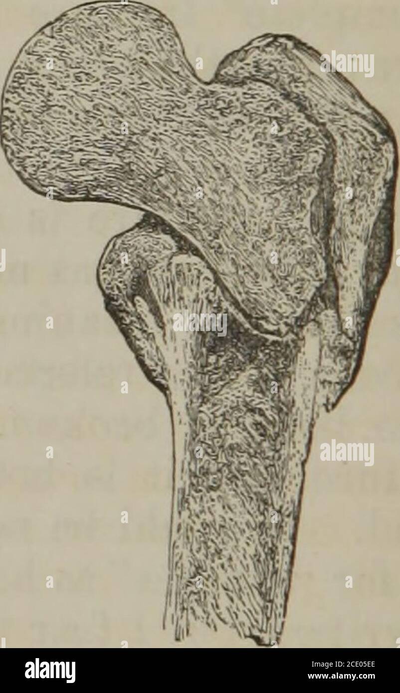 A practical treatise on fractures and dislocations . Longitudinal and  oblique fracture. Impacted extra-capsular fracture of neck of femur. A Serrated  fracture is one in which the opposite surfaces denti-culate, the