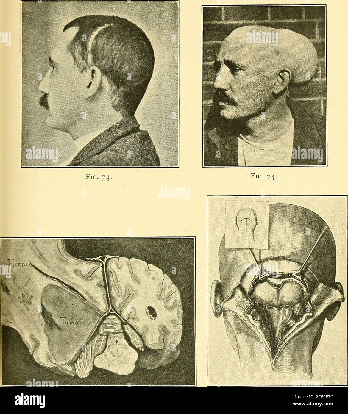 . Some points in the surgery of the brain and its membranes . n. No patient should be allowedto become blind from optic neuritis. A woman, aged forty-one years, was admitted to theNational Hospital, under Dr. Buzzard, with symptomspointing to tumour pressing on the internal capsule :hemianassthesia, hemiplegia, severe headache, and failingsight from optic neuritis. She became comatose aftera paroxysm of pain. I opened the skull and dura.Consciousness returned, and the headache, optic neuritis,and vomiting were completely relieved. There waseven, a month later, some return of power and sensatio Stock Photo